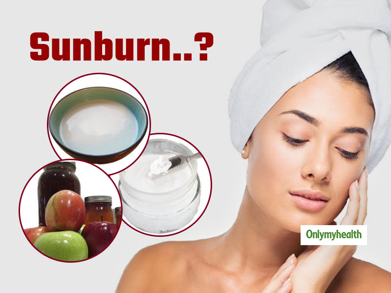 Effective Home Remedies for Sunburn Relief