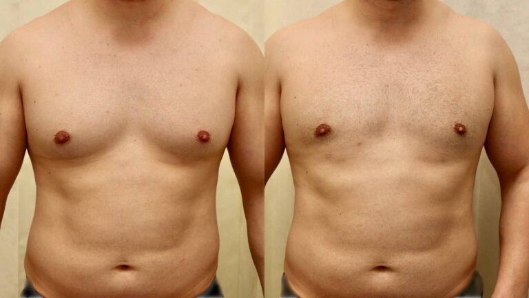 The Psychological Impact of Gynecomastia Surgery Scars